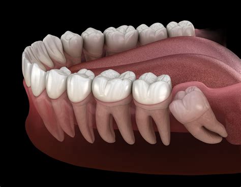 Molars and Wisdom Teeth: Function and Problems .